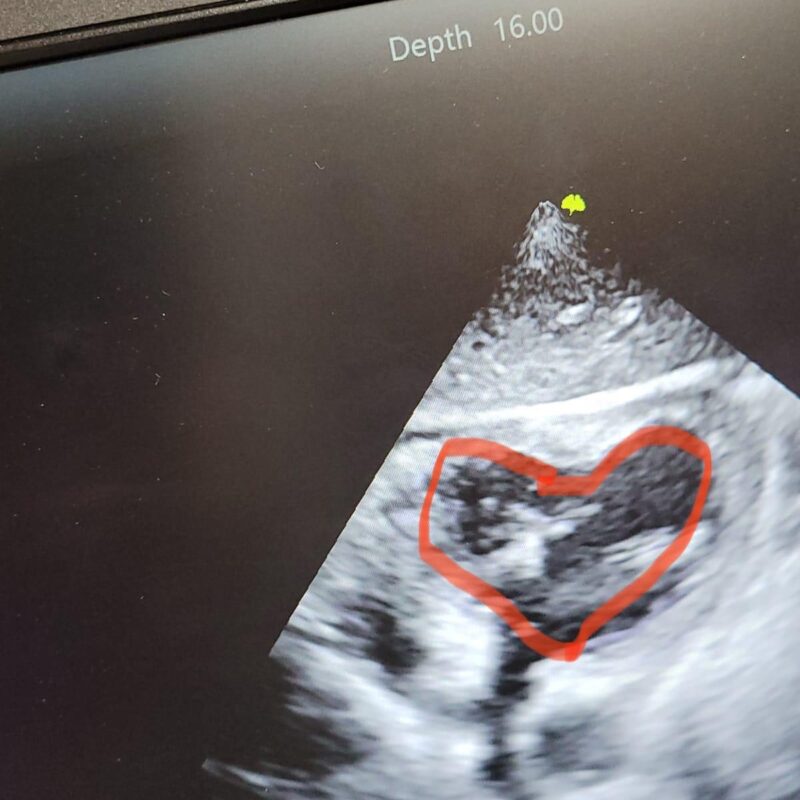 Echo Scan of Heart of a 7 Year old Patient